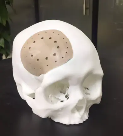 3d printing in medical field